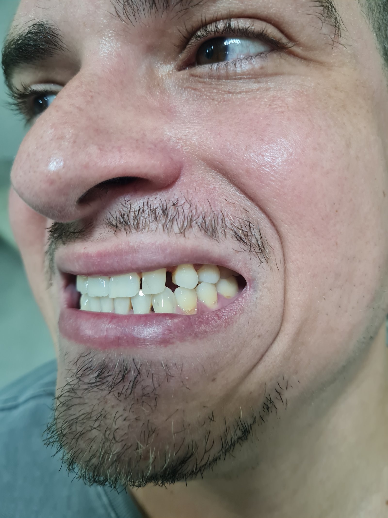 Antes do tratamento - Lentes de contato dental