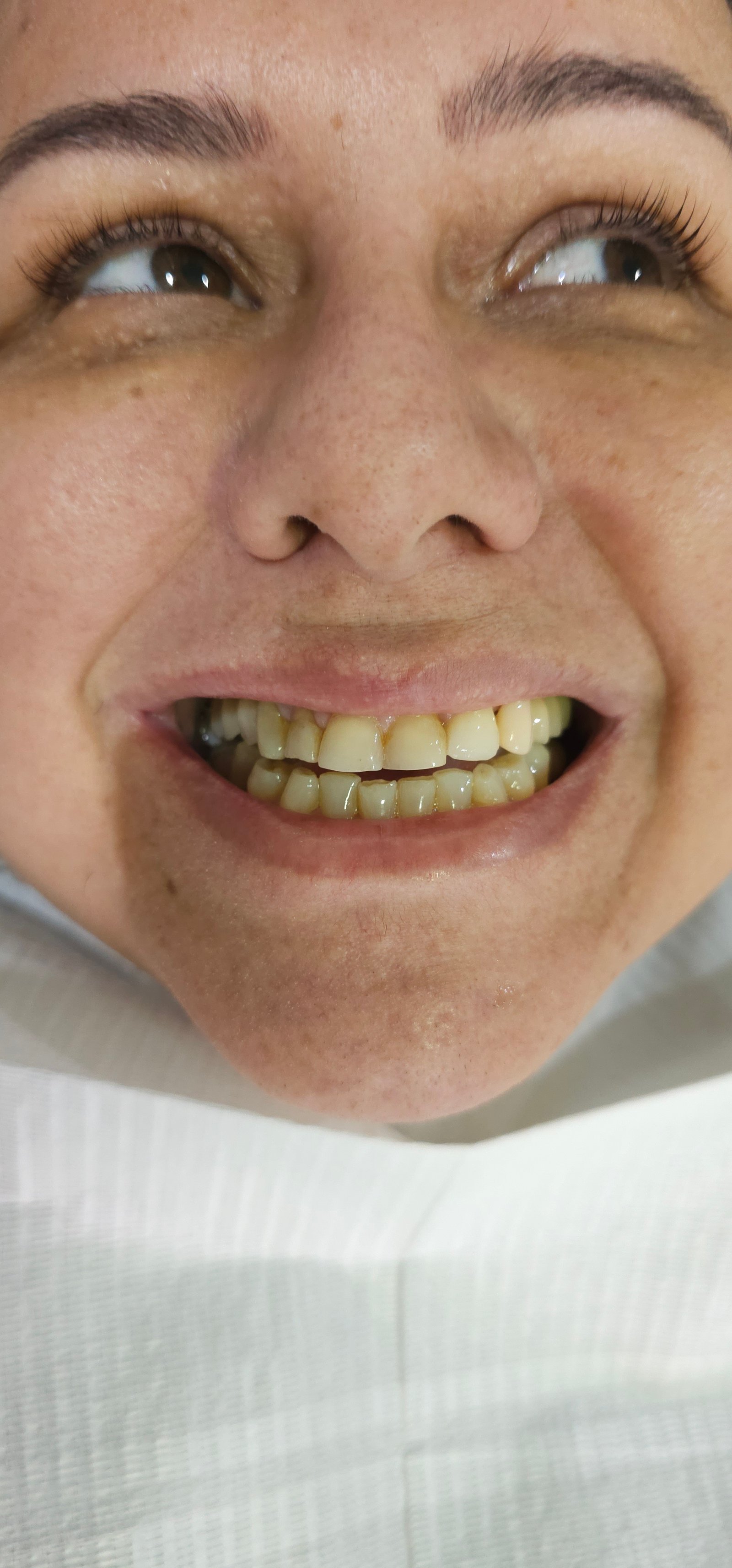 Antes do tratamento - Lentes de contato dental