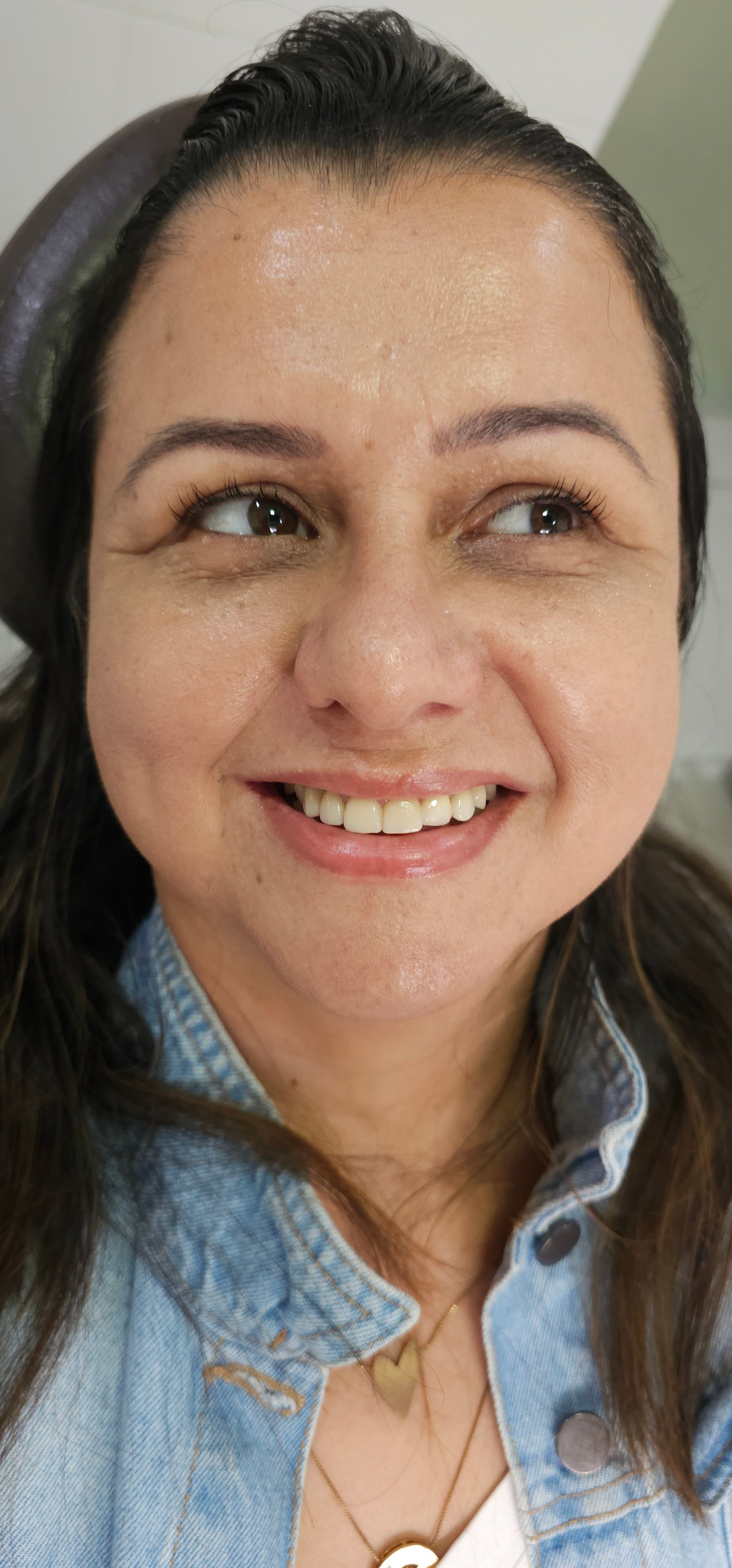 Depois do tratamento - Lentes de contato dental